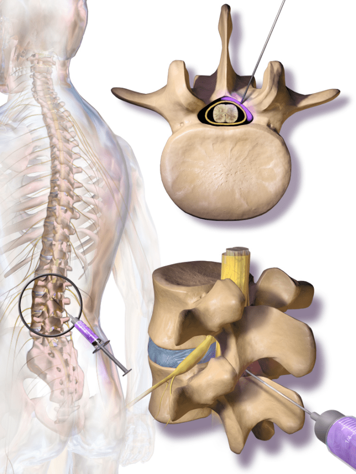 Treatment For Chronic Neck And Back Pain Epidural Steroid Injections YouMeMindBody