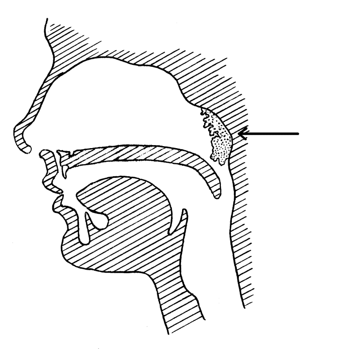 The arrow points to where the adenoids are located.
