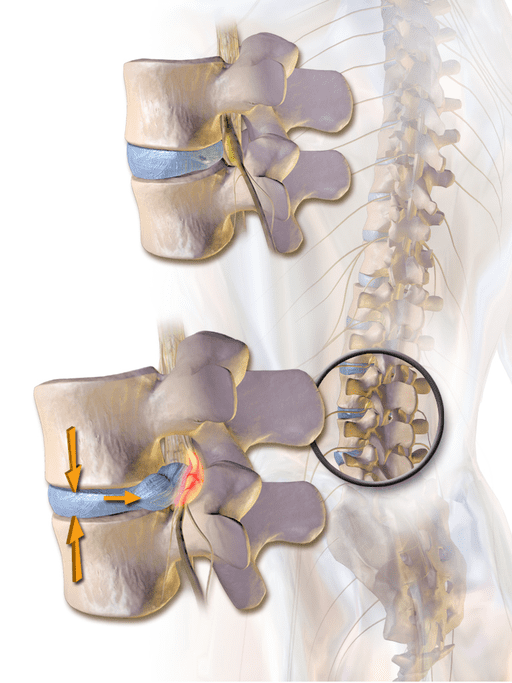 A slipped disc is a medical condition whereby the outer, fibrous ring of an intervertebral disc ruptures and allows the soft, central portion to bulge out, pressing against the spinal cord and triggering a sensation of pain