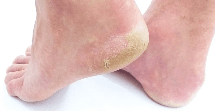 Citronella essential oil has anti-fungal properties and can be used to help treat athlete's foot, ring worm, toenail fungus, and jock itch.