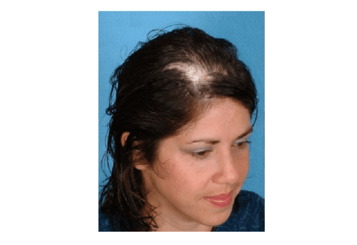 Scarring alopecia