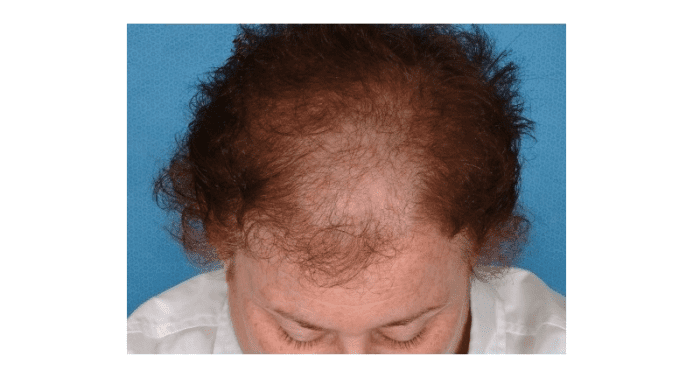Androgenetic alopecia