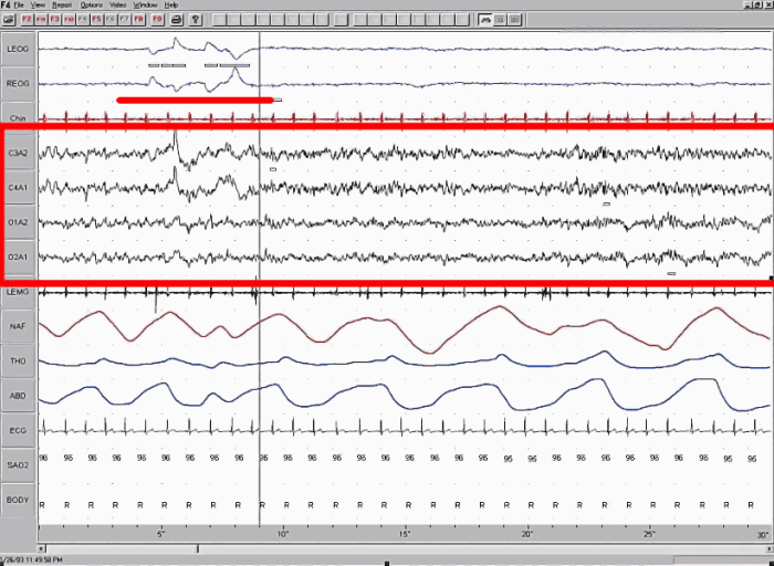 REM sleep demonstrates an increase of brain activity (similar to wakefulness), while the body remains immobilized.