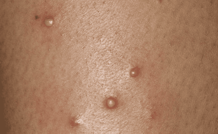 Vaginal Folliculitis might look like this: It begins as small red bumps or whiteheads and develops into infected, crusty sores.