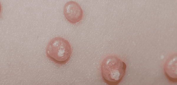 Molluscum Contagiosum: Smooth, round bumps of varying size, with a central indentation, firm to the touch, and filled with a waxy substance.