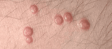 Vaginal warts: Skin-colored, itchy bumps, with the appearance of cauliflower, that are rough to the touch.