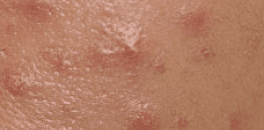 Vaginal / Vulval Acne: Vaginal pimples are like face pimples or those found elsewhere on the body.