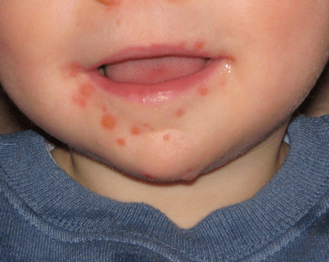 These lesions are caused by hand, foot, and mouth disease in an 11-month-old male.