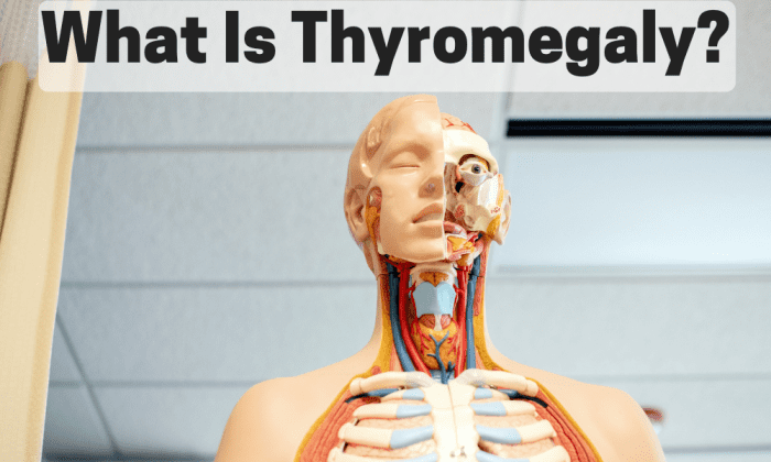 Thyromegaly, also known as goiter, is the enlargement of the thyroid gland and it can cause series health complications.