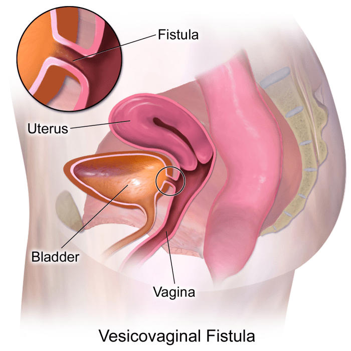 how-events-and-decisions-made-early-in-life-ultimately-influence-the-development-of-the-vesico-vaginal-fistula-vvf