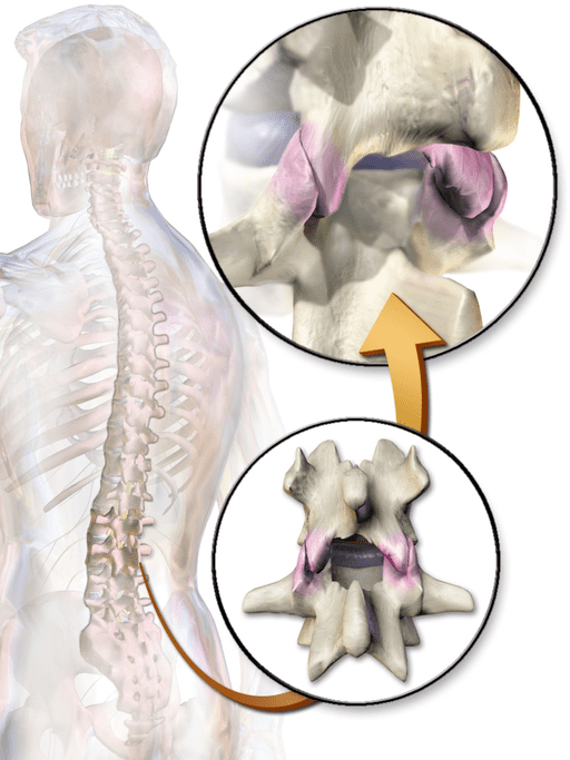 Treatment for Chronic Back Pain Facet Injections and Radiofrequency