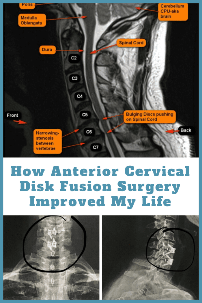 How Anterior Cervical Disk Fusion Surgery Improved My Life Patient S Lounge