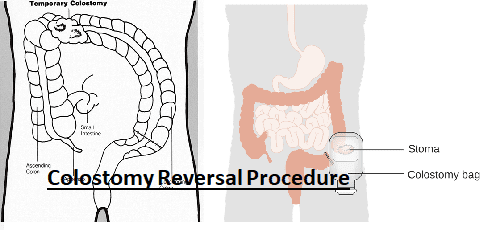 Ostomy Reversal Procedure: My Story - Patient's Lounge