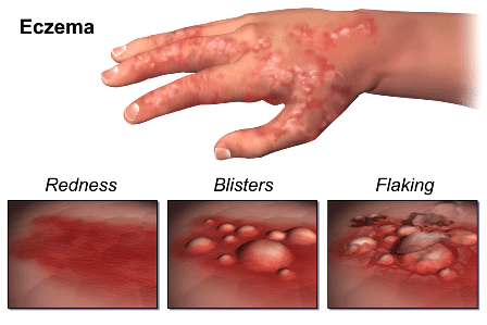How Eczema Breaks Out