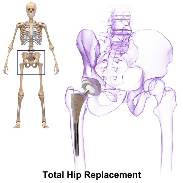 Diagram of Total Hip Replacement