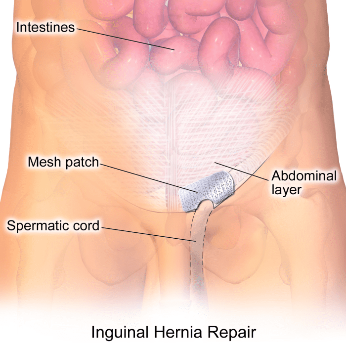 Hernias are usually fixed by putting the protruding tissue back in place and reinforcing the opening with a sterile mesh.