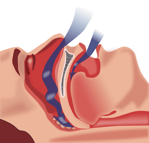 The snoring sound varies depending on how narrow the airway gets. The less space there is left for the air to pass through, the louder the snoring becomes.