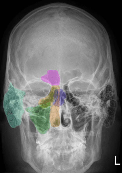 Sinuses, with right side color coded. Frontal sinus is purple, ethmoid yellow, sphenoid blue, and maxillary sinus in green. The aqua green to the far left is the mastoid cells.
