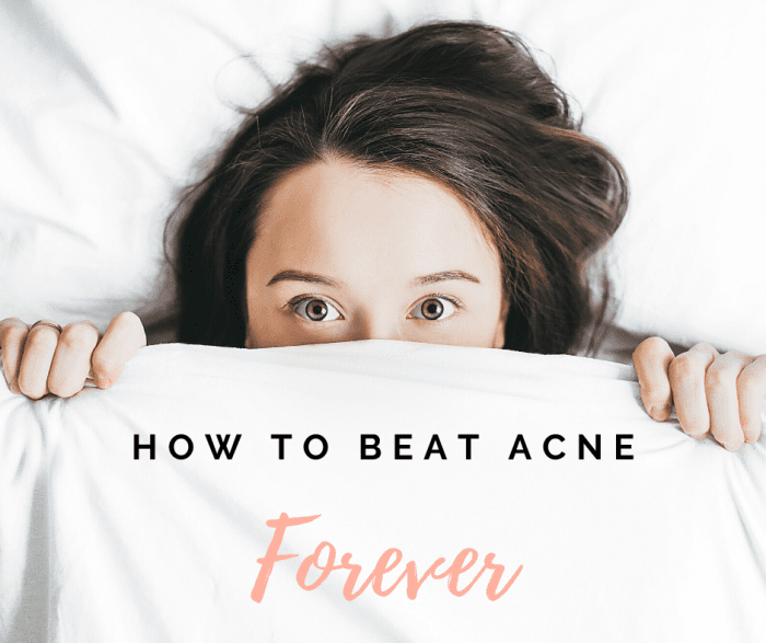 Follow along for three easy ways to banish acne. There's no need to hide your face anymore!