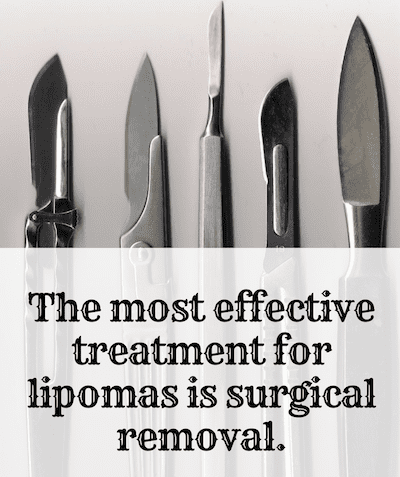 The best way to get rid of your lipoma is to have it surgically removed. However, this is not always necessary.