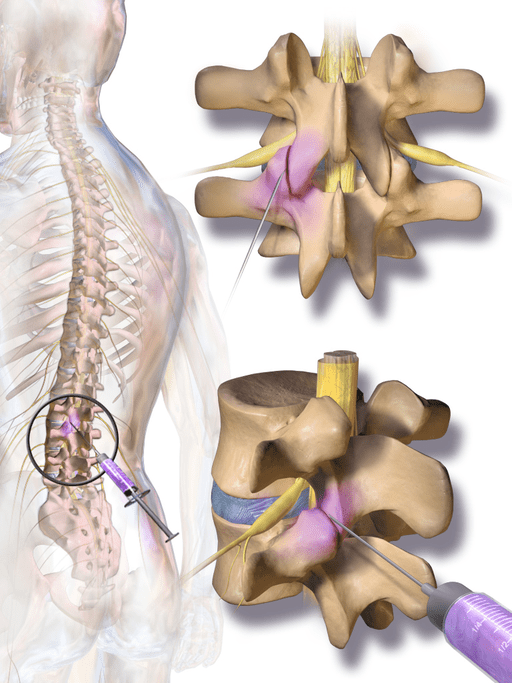 Treatment for Chronic Back Pain Facet Injections and Radiofrequency