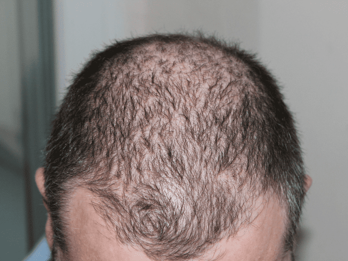 Others are less likely to notice you are balding if you start using hair loss concealer the moment your scalp becomes visible through your hair.