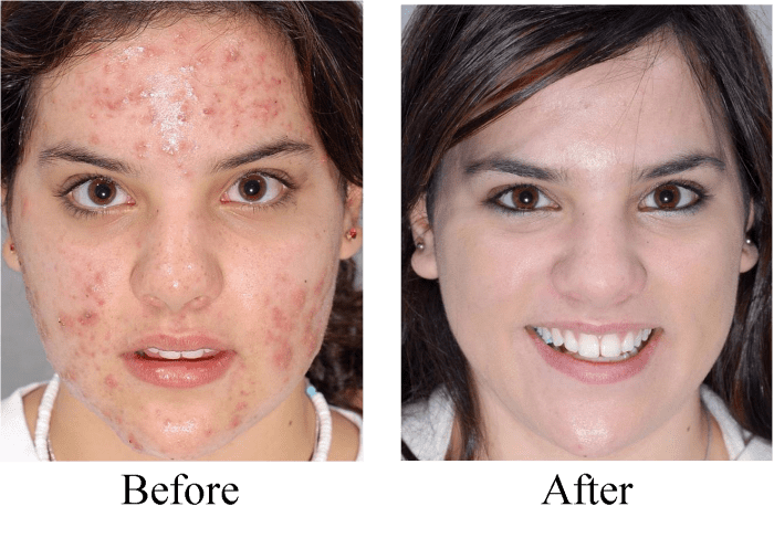 acne scars before and after