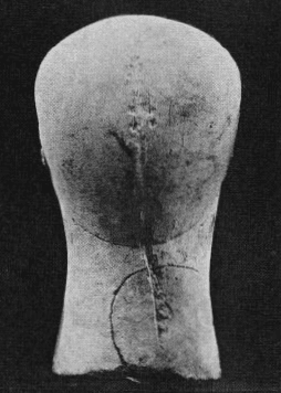 An example of mutilation on the back of the head