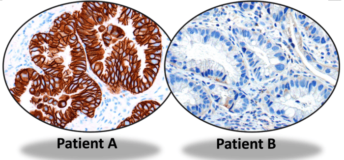 Laboratory tests showing HER-2 positive in breast cancer from patient A but negative from patient B. Anti-HER-2 treatment might be effective for patient A but may not be beneficial for patient B.