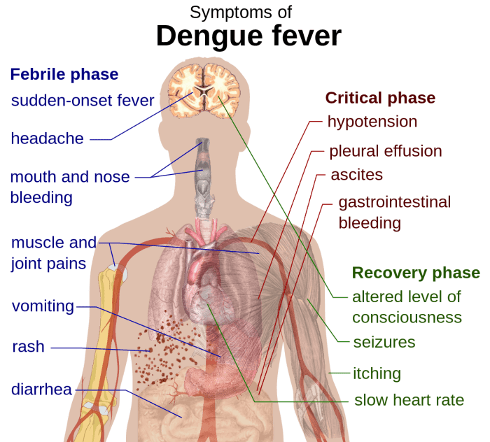 A list of potential symptoms of dengue