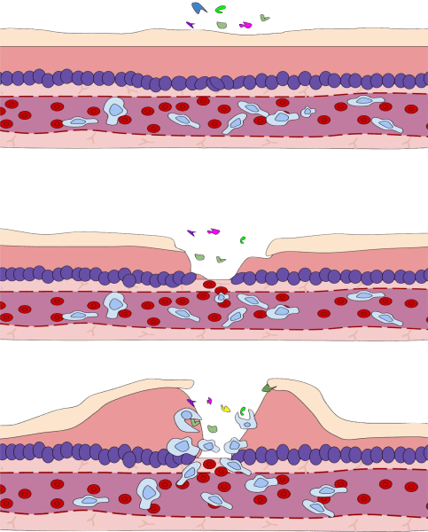 Inflammation is a process by which the body's white blood cells and substances they produce protect us from infection with foreign organisms, such as bacteria and viruses.