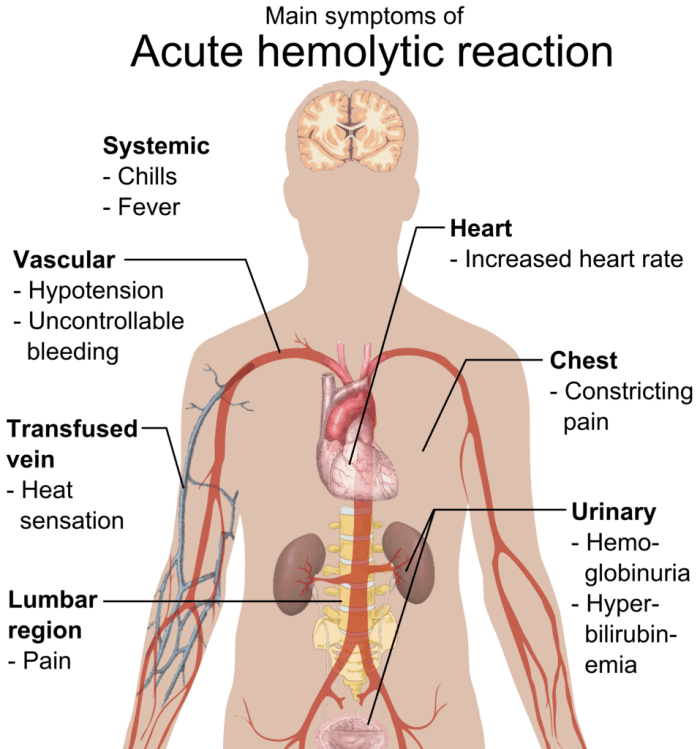 Hemolysis is the rupturing of red blood cells. One cause of the condition is the mixing of incompatible blood types.