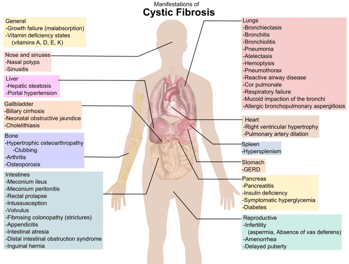 Cystic Fibrosis affects the body in many ways, but carriers of the gene have an advantage when faced with diarrhea-causing diseases.