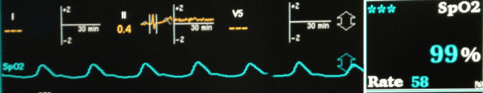 The pulse oximeter shows the heartbeats and displays the percent saturation of the blood with oxygen.