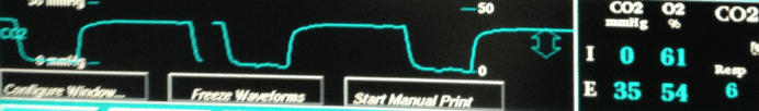 Breathing is shown here with expiration displayed as the CO2 is breathed out (blue line). The end-tidal CO2 is displayed as a number (35). The percent oxygen breathed in (61) and out (54) is also shown. The respiratory rate is 6.