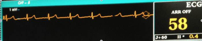 The EKG displays the heart rate and rhythm and gives other information about the health of the heart, as well.