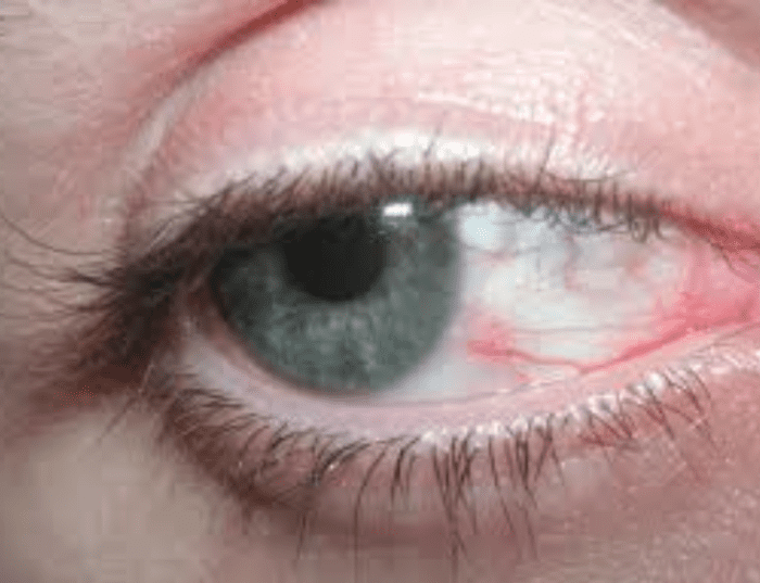 I was always rubbing my eyes like there was something gritty that I could get out. Eye drops were the only thing that helped but just for a little while