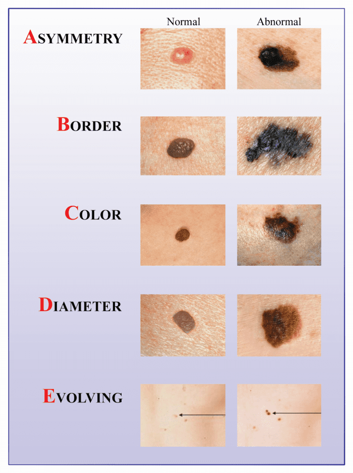 Take The Time To Check Your Body For Skin Signs Of Skin Cancer. Do It Yourself Using A Mirror, Or Enlist A Friend