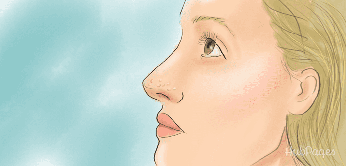Milia are also called "whiteheads." They are tiny cysts, often on the skin around the eyes, nose, or mouth.