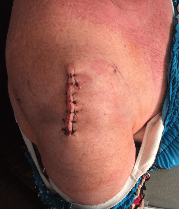 This photo was taken immediately after the surgical dressing was removed on the third day post-op. Because I am allergic to metal staples, I have to have hand sewn stitches. Love that because it makes for a much "prettier" scar.