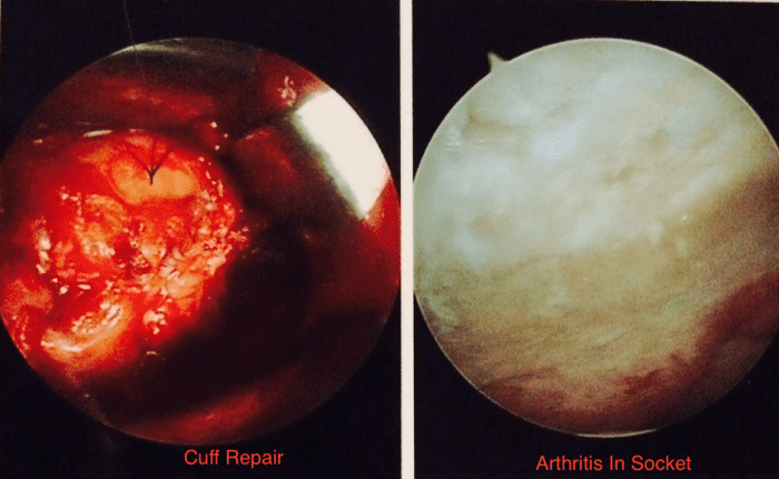 Here's the cuff repair and photo of the extensive arthritis before it was cleaned up. The surgeon had to use both techniques, arthroscopic and direct visualization (open incision) because of the extent of repairs required.