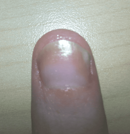 Nail Psoriasis with Fungus (My Left Thumb Nail) Recently treated with steroid injections, and daily with my nail oil, and Vicks.