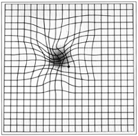 What a person would see with severe macular pucker. Since the condition affects the macula, the symptoms are nearly similar to macula degeneration.