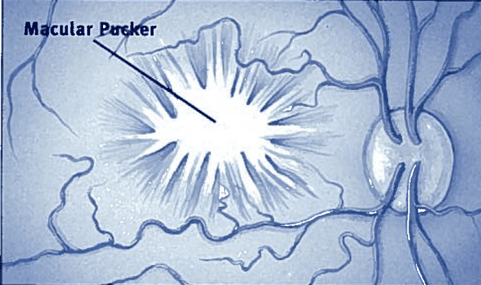 A diagram of what the scar tissue looks like on the retina. Also known as the epiretinal membrane.