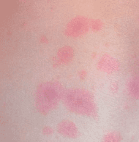 HIV Rash: Images, Symptoms, Location, and Treatment - HubPages