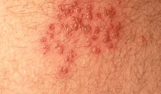 HIV Rash: Images, Symptoms, Location, and Treatment - HubPages