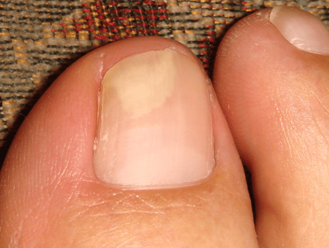 Still remains the same weeks after using the topical treatment. In fact, it was only getting better after I switched to wearing slippers for more "breath-ability" on my feet.