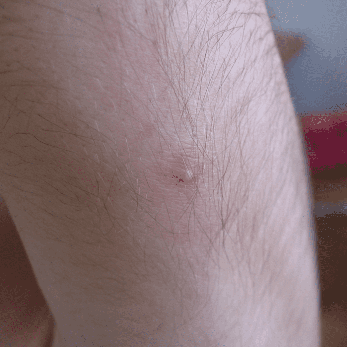 Acne vulgaris, in this case on the arm, can also appear on the thighs or buttocks.