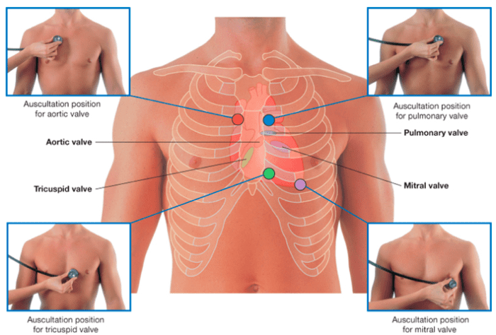 Heart Sounds are produced by deceleration of blood impinging on elastic structures in the heart, giving rise to vibration