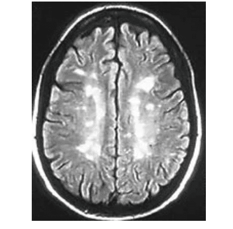 This is a 2010 MRI with Multiple Sclerosis brain lesions. The doctors stopped counting after 23 lesions.